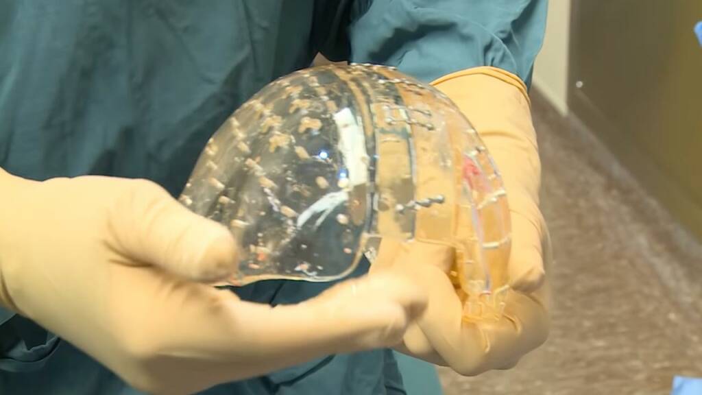 Cráneo creado en impresora 3D fue implantado en mujer