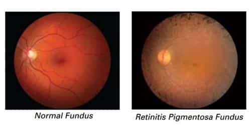 Retinitis Pigmentosa La retinitis pigmentosa es una enfermedad hereditaria y sería el problema para quienes consumen Viagra.