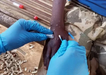 Oms Viruela Símica Mpox Africa - mpox
